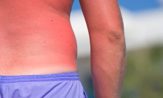 Έγκαυμα: Τι να κάνετε αν καείτε από τον ήλιο – Παραδείγματα